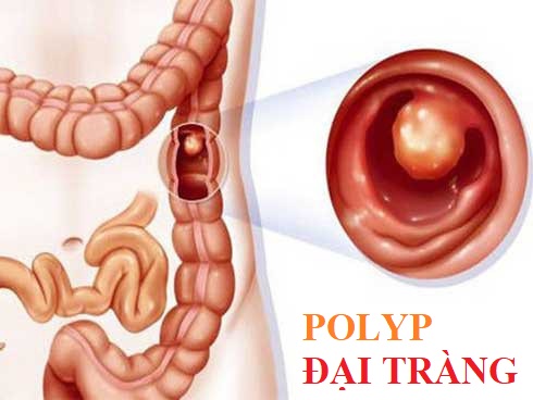 Tìm hiểu về polyp đại tràng và các yếu tố gây bệnh